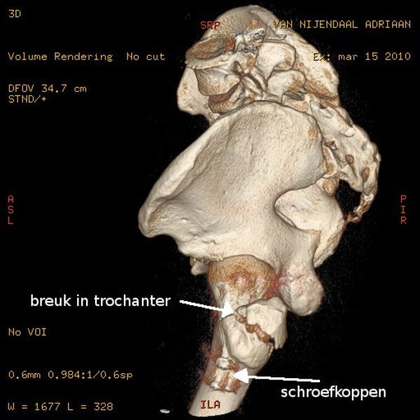 CT scan van een dubbele fractuur